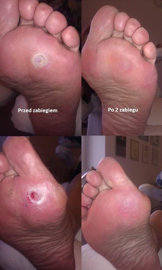 Gabinet Podologiczny ZDROWE STOPY specjalista ds.podologii Mirosława Lazar. — zdjęcie 4